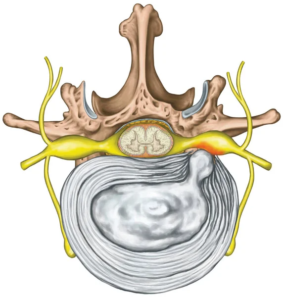 Lumbar Disk Herniation Herniated Disc Lumbar Vertebra Lumbar Spine Intervertebral — Foto Stock