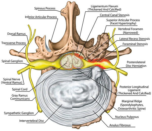 Stenosis, lumbar disk herniation, herniated disc, lumbar vertebra, osteophytes, spondylophytes, intervertebral disk, nervous system, nerve root, spinal cord, arthrosis, vertebra, anatomy of human skeletal and nervous system, superior view