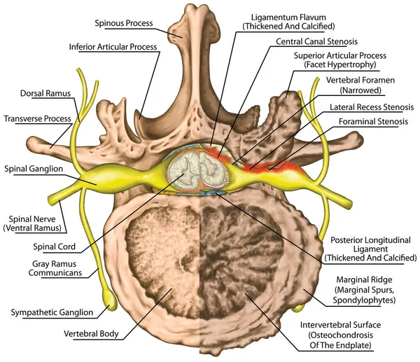 Central Lateral Stenosis Second Lumbar Vertebra Nervous System Spinal Cord — ストック写真