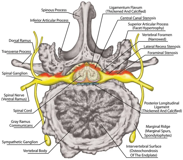 Central Lateral Stenosis Second Lumbar Vertebra Nervous System Spinal Cord Zdjęcia Stockowe bez tantiem