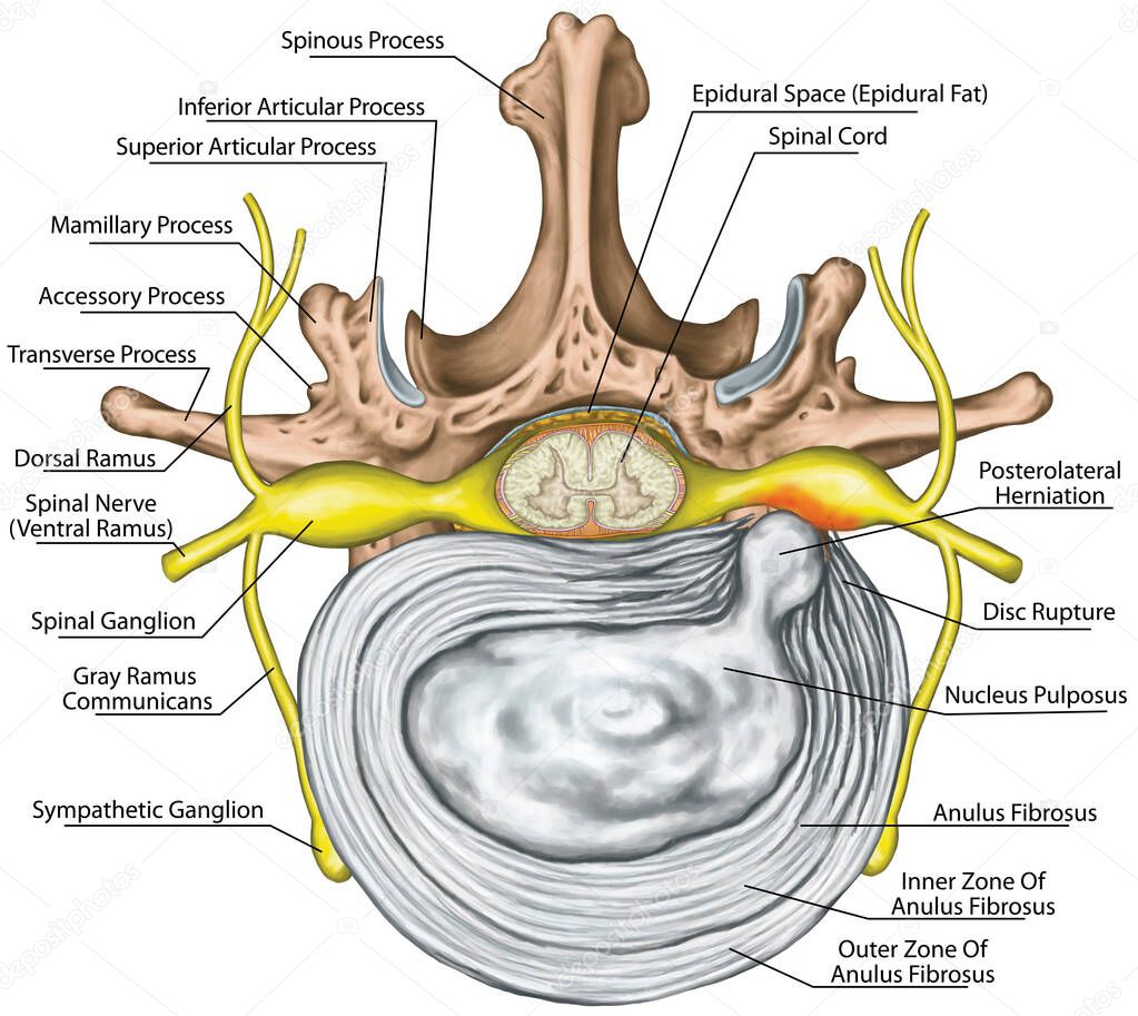 Lumbar disk herniation, herniated disc, lumbar vertebra, lumbar spine, intervertebral disk, nervous system, nerve root, spinal cord, vertebra, anatomy of human skeletal and nervous system, superior view