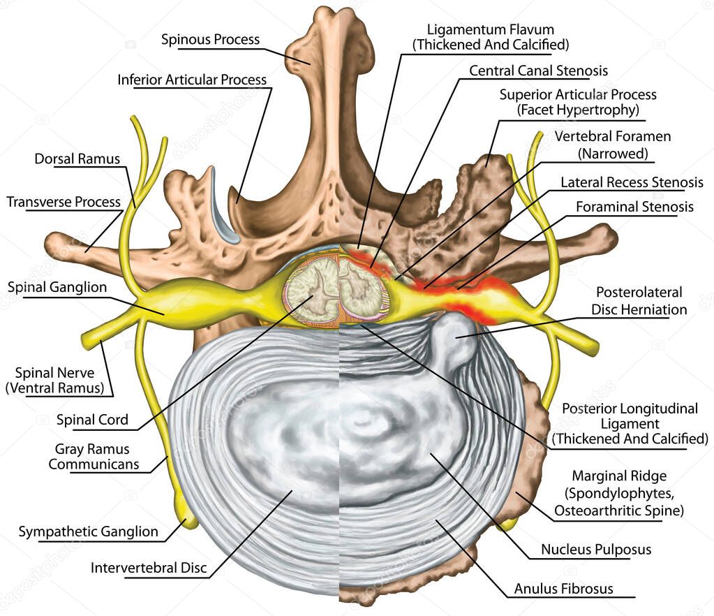 Stenosis, lumbar disk herniation, herniated disc, lumbar vertebra, osteophytes, spondylophytes, intervertebral disk, nervous system, nerve root, spinal cord, arthrosis, vertebra, anatomy of human skeletal and nervous system, superior view