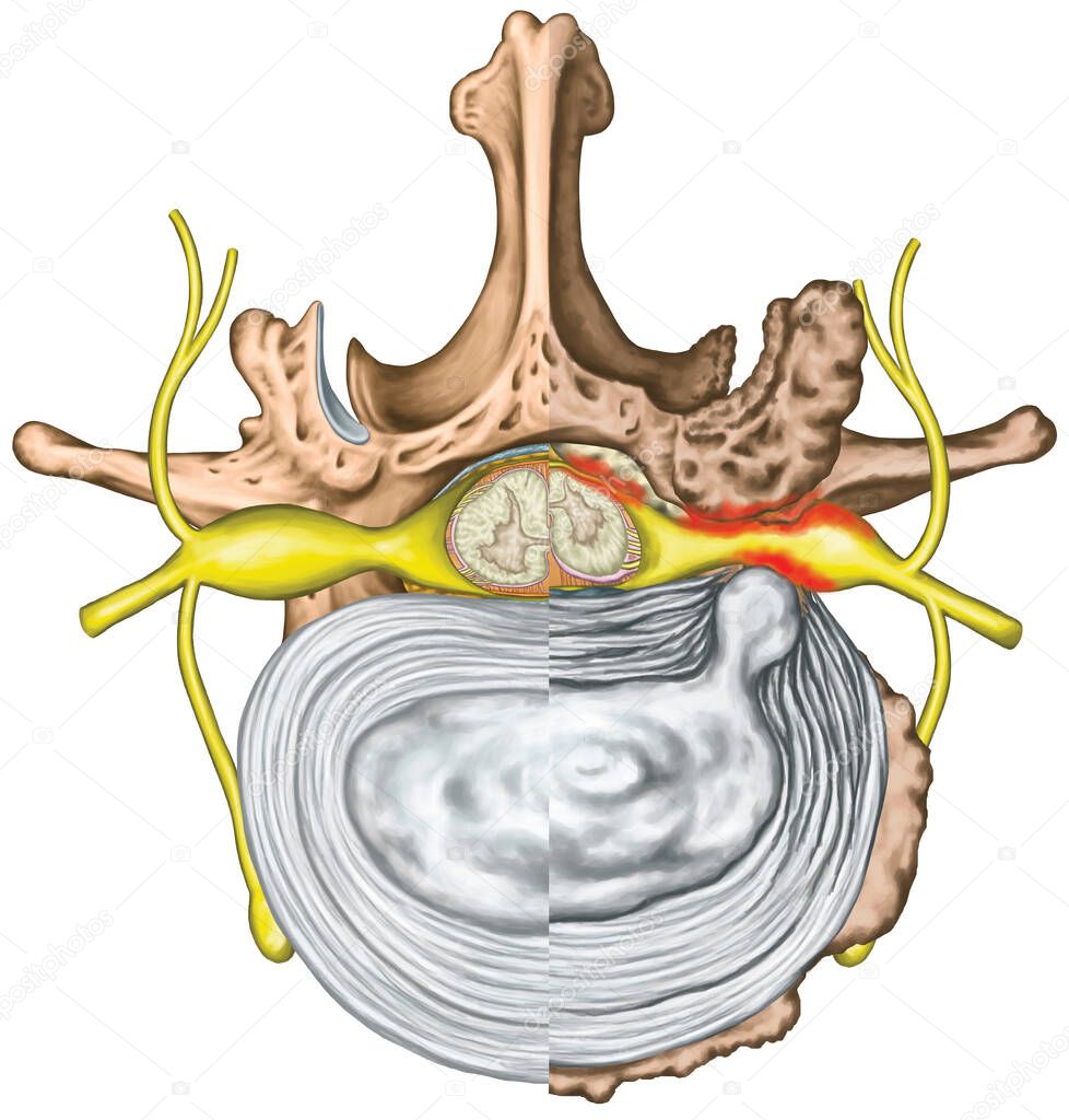 Stenosis, lumbar disk herniation, herniated disc, lumbar vertebra, osteophytes, spondylophytes, intervertebral disk, nervous system, nerve root, spinal cord, arthrosis, vertebra, anatomy of human skeletal and nervous system, superior view