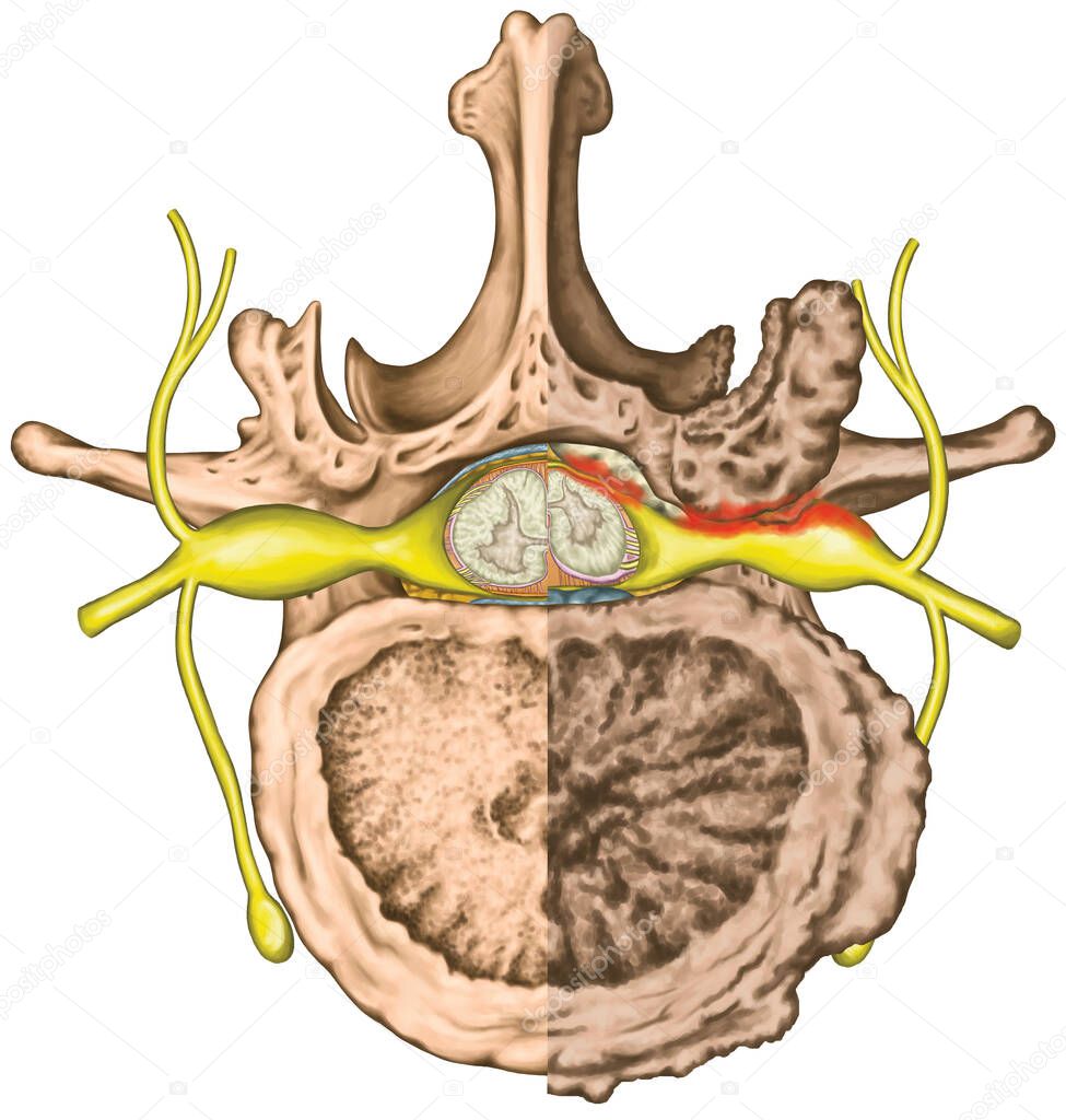 Central lateral stenosis, second lumbar vertebra, nervous system, spinal cord, lumbar spine, nerve root, advanced uncovertebral arthrosis of the lumbar vertebra, degenerative changes vertebra, osteophytes, spondylophytes, osteoarthritis of the joints
