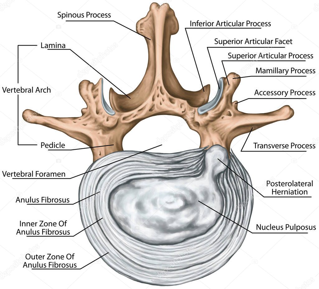 Lumbar disk herniation, herniated disc, lumbar vertebra, lumbar spine, intervertebral disk, anulus fibrosus, nucleus pulposus, vertebral bones, vertebra, anatomy of human skeletal system, superior view