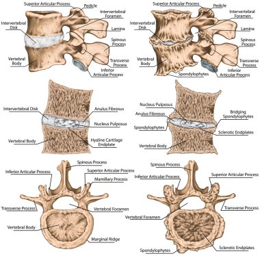 Didactic board, spondylophytes involving a spinal motion segment, advanced uncovertebral arthrosis, third and fourth lumbar vertebrae, degenerative changes vertebra, lumbar vertebra,  lumbar spine, vertebral bone clipart