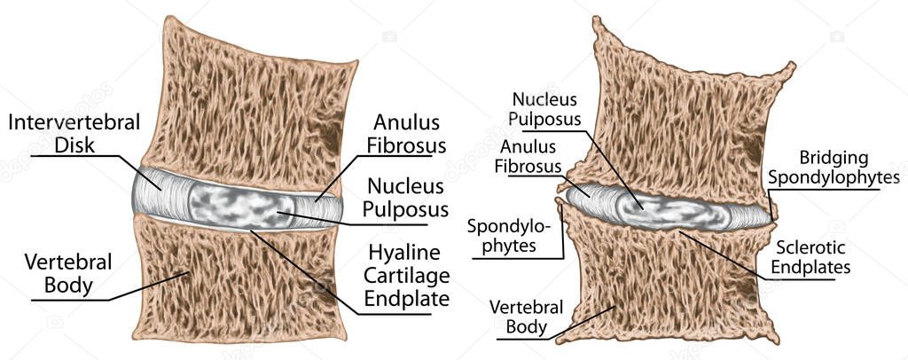 Coronal section through the third and fourth lumbar vertebrae, narrowing of the intervertebral disk space, sclerosis of the vertebral endplate, osteophytes, spondylophytes, chondrosis, osteochondrosis, spondyloarthrosis