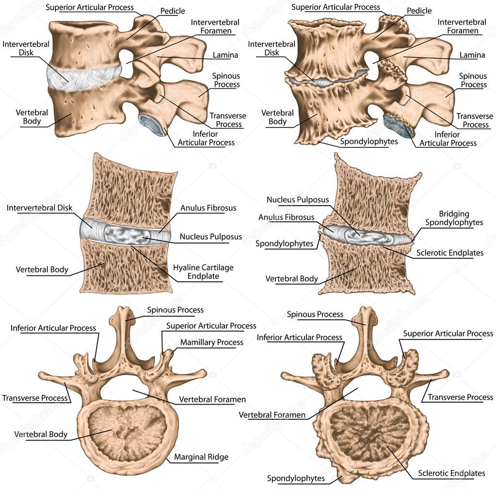 Didactic board, spondylophytes involving a spinal motion segment, advanced uncovertebral arthrosis, third and fourth lumbar vertebrae, degenerative changes vertebra, lumbar vertebra,  lumbar spine, vertebral bone