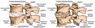 Spondylophytes involving a spinal motion segment, advanced uncovertebral arthrosis, third and fourth lumbar vertebrae, degenerative changes vertebra, lumbar vertebra,  lumbar spine, vertebral bone, lateral view