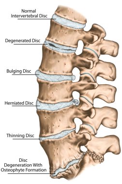 Spine disc problems, degenerative lumbar disc disease, degenerative disc disorder, degenerated disk, bulging disk, herniated disk, thinning disk, disk degeneration with osteophyte formation