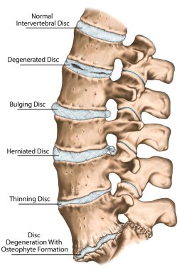 Spine disc problems, degenerative lumbar disc disease, degenerative disc disorder, degenerated disk, bulging disk, herniated disk, thinning disk, disk degeneration with osteophyte formation clipart