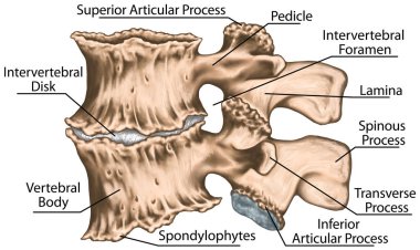 Spondylophytes involving a spinal motion segment, third and fourth lumbar vertebrae, advanced uncovertebral arthrosis, degenerative changes vertebra, osteophytes, osteoarthritis of the joints, lumbar vertebra,  lumbar spine, vertebral bone clipart