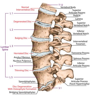Spine disc problems, degenerative lumbar disc disease, degenerative disc disorder, degenerated disk, bulging disk, herniated disk, thinning disk, disk degeneration with osteophyte formation