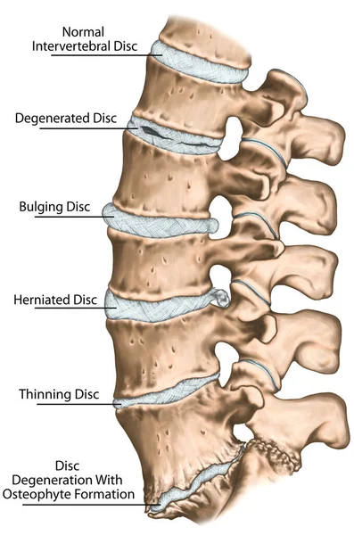 Spine Disc Problems Degenerative Lumbar Disc Disease Degenerative Disc Disorder — Stock Fotó