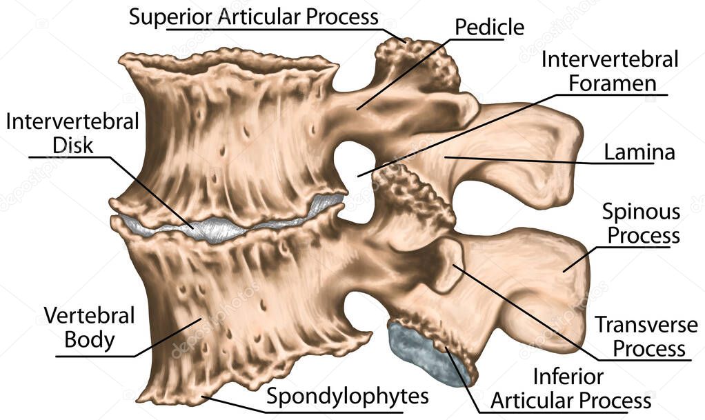 Spondylophytes involving a spinal motion segment, third and fourth lumbar vertebrae, advanced uncovertebral arthrosis, degenerative changes vertebra, osteophytes, osteoarthritis of the joints, lumbar vertebra,  lumbar spine, vertebral bone