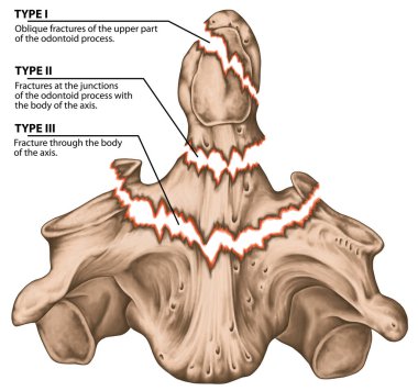Üç tip odontoid kırığı. Eksen kırıkları var. Belirsiz avülsiyon kırıkları, eksenin gövdesiyle mağaraların kesişimlerinde çatlaklar, eksenin gövdesine doğru uzanan çatlaklar.. 