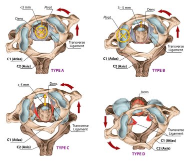 Atlas 'ta travmatik rotasyon, sublüks ve çıkık. Dört çeşit atlantoaxial rotasyon subluksasyonu. Fielding ve Hawkins sınıflandırması. Üstün görünüm.