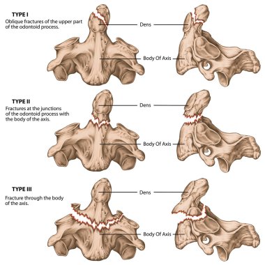 Üç tip odontoid kırığı. Eksen kırıkları var. Belirsiz avülsiyon kırıkları, eksenin gövdesiyle mağaraların kesişimlerinde çatlaklar, eksenin gövdesine doğru uzanan çatlaklar.. 