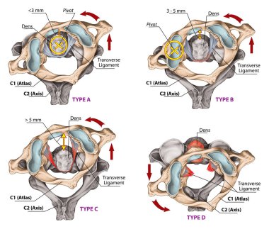 Atlas 'ta travmatik rotasyon, sublüks ve çıkık. Dört çeşit atlantoaxial rotasyon subluksasyonu. Fielding ve Hawkins sınıflandırması. Üstün görünüm.