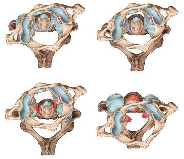 Atlas 'ta travmatik rotasyon, sublüks ve çıkık. Dört çeşit atlantoaxial rotasyon subluksasyonu. Fielding ve Hawkins sınıflandırması. Üstün görünüm.