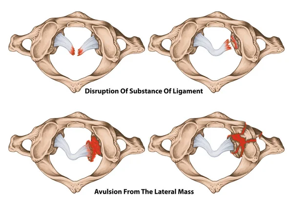 Classificatie Van Dwarse Ligamentletsels Onderbrekingen Als Het Middengedeelte Parodie Inbrengen — Stockfoto