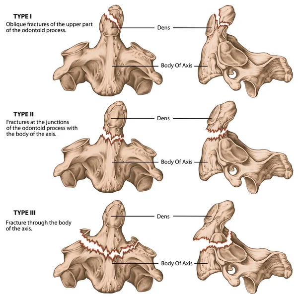 Три Типа Одонтоидных Переломов Переломы Оси Неровные Переломы Переломы Стыках — стоковое фото