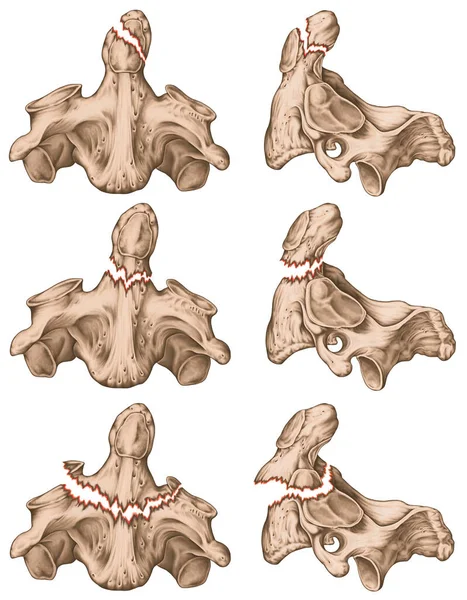 有三种类型的齿状骨折 轴的断裂 斜撕脱骨折 洞口的骨折与轴体的接合部骨折 骨折延伸至轴体 — 图库照片