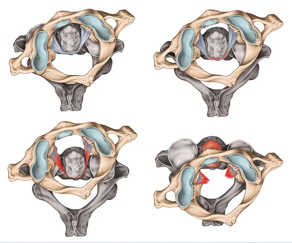 Traumatische Rotationsverlagerung Des Atlas Subluxation Und Dislokation Die Vier Arten — Stockfoto