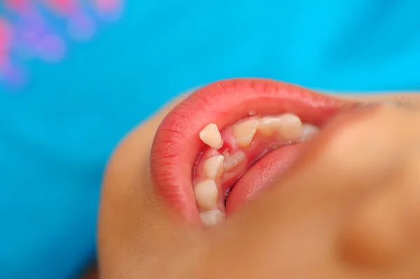 Child loose tooth — Stock Photo, Image