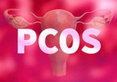 PCOS - Polisistik yumurtalık sendromu, pembe arka planda ve rahimde. 3B görüntüleme