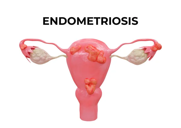 Endometriyozis, rahim boşluğu dışında ve diğer organlarda endometriyumun varlığıyla karakterize edilen bir hastalıktır. 3B illüstrasyon
