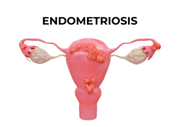 Ендометріоз Захворювання Яке Характеризується Наявністю Ендометрію Поза Порожниною Матки Інших — стокове фото