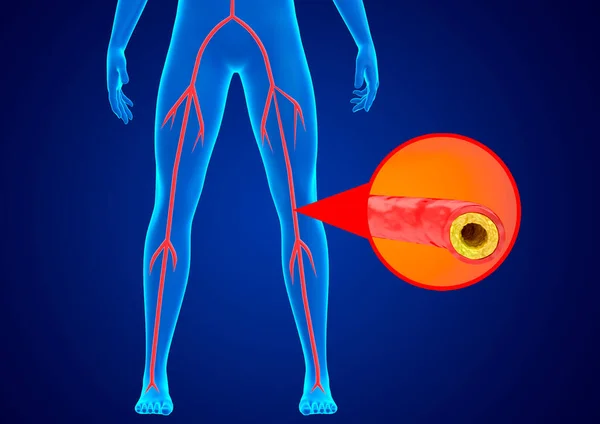 Peripheral Arterial Disease Accumulation Fat Calcium Walls Arteries Lower Limbs — 스톡 사진