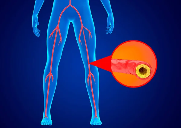 Peripheral Arterial Disease Accumulation Fat Calcium Walls Arteries Lower Limbs —  Fotos de Stock