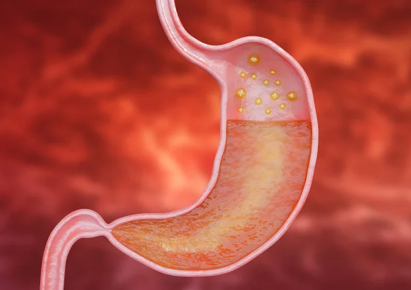 Gastritis Una Inflamación Del Revestimiento Interno Del Estómago Que Causa — Foto de Stock
