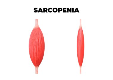 Sarcopenia is the loss of muscle mass, a common occurrence after age 50. 3D illustration clipart