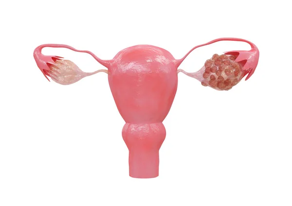 多囊性卵巢炎综合征 Polycystic Ovary Syndrome 是一种激素紊乱 导致卵巢尺寸增大 卵巢外部有小囊肿 3D插图 — 图库照片