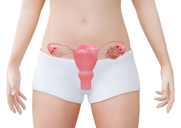 Polycystic Ovary Syndrome Hormonal Disorder Causes Increase Size Ovaries Small — Stok Foto