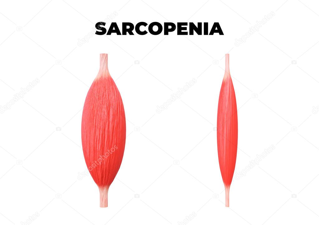 Sarcopenia is the loss of muscle mass, a common occurrence after age 50. 3D illustration