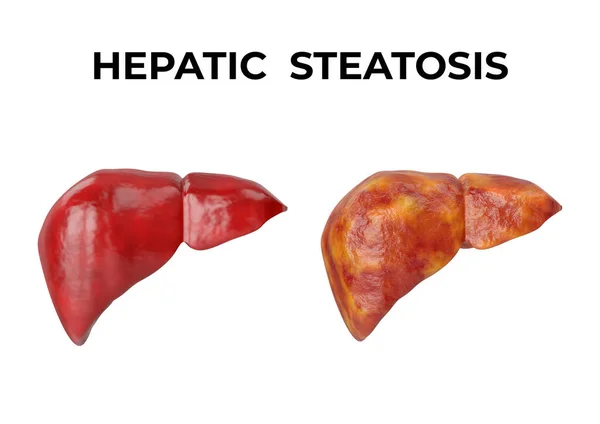 Jaterní Steatóza Onemocnění Charakterizované Hromaděním Tuku Jaterních Buňkách Ilustrace — Stock fotografie