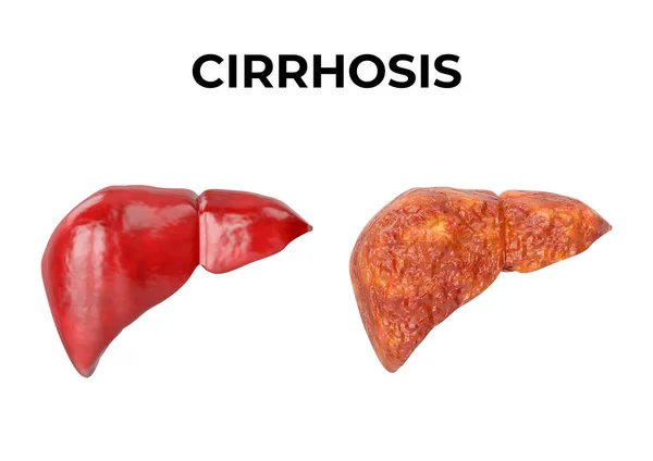 Liver Cirrhosis Chronic Inflammation Liver Fibrous Tissue Replaces Normal Liver — Stock Photo, Image