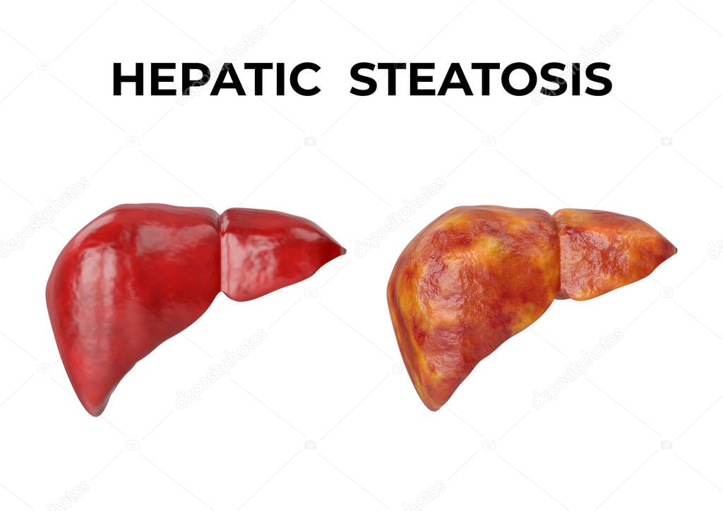 Hepatic steatosis is a disorder characterized by the accumulation of fat inside the liver cells. 3D illustration