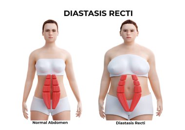 Karın diastazisi, rektus abdominis kaslarının hamilelik sırasında ve sonrasında sıklıkla görülen kısmi ya da tam ayrılmasıdır. 3B illüstrasyon
