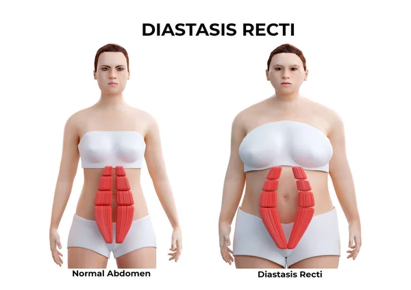 Karın diastazisi, rektus abdominis kaslarının hamilelik sırasında ve sonrasında sıklıkla görülen kısmi ya da tam ayrılmasıdır. 3B illüstrasyon