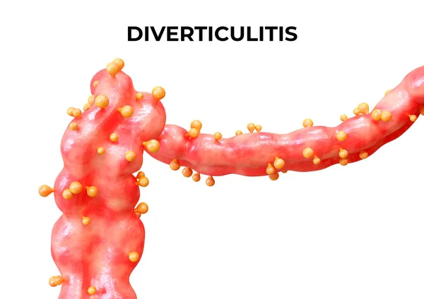 Diverticulitis Disease Occurs Diverticula Large Intestine Become Inflamed Infected May — Stock Photo, Image