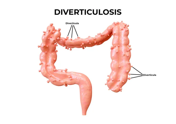 Diverticulose Uma Doença Gastrointestinal Qual Divertículos Formam Intestino Ilustração — Fotografia de Stock