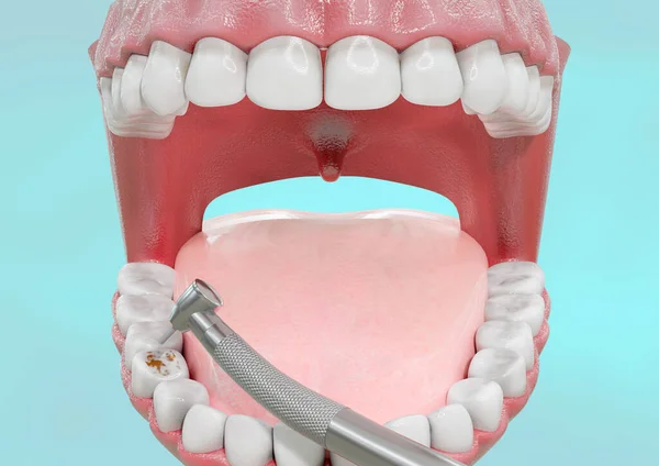 人間の歯はドリルマシンで除去プロセスを運ぶ 3Dイラスト — ストック写真