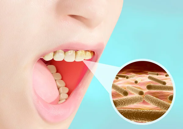 Bakteriální Infekce Kolonií Lidských Zubech Důsledku Nedostatečné Ústní Hygieny Ilustrace — Stock fotografie