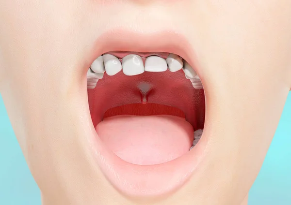 Pokřivené Překrývající Přeplněné Lidské Zuby Pro Ortodontickou Korekci Ilustrace — Stock fotografie