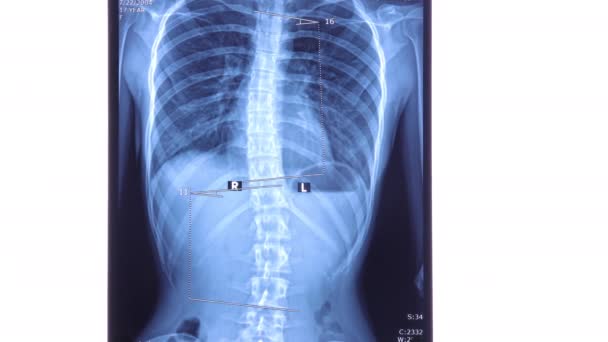 腰部領域では脊椎症を示すX線 陰嚢症は背骨の異常な横曲率です ドリーショット4K — ストック動画